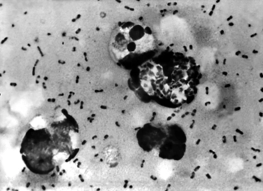 Centers for Disease Control and Prevention/Getty Images
